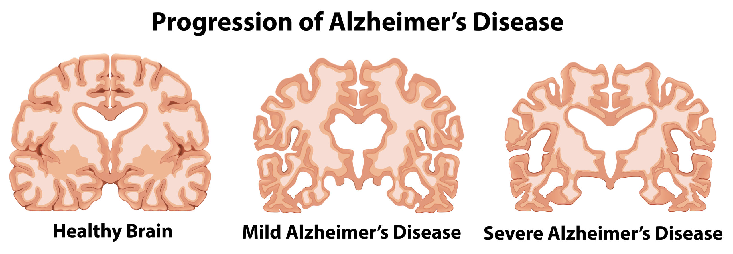 AD-Alzheimer's is a progressive disease, where dementia symptoms gradually worsen over a number of years. In its early stages, memory loss is mild, but with late-stage Alzheimer's, individuals lose the ability to carry on a conversation and respond to their environment.